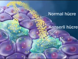 İşte kanserin 7 belirtisi